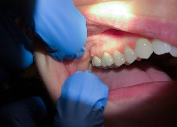 Best Emergency Treatment for Dental Infections or Abscesses in Virginia Gardens, FL